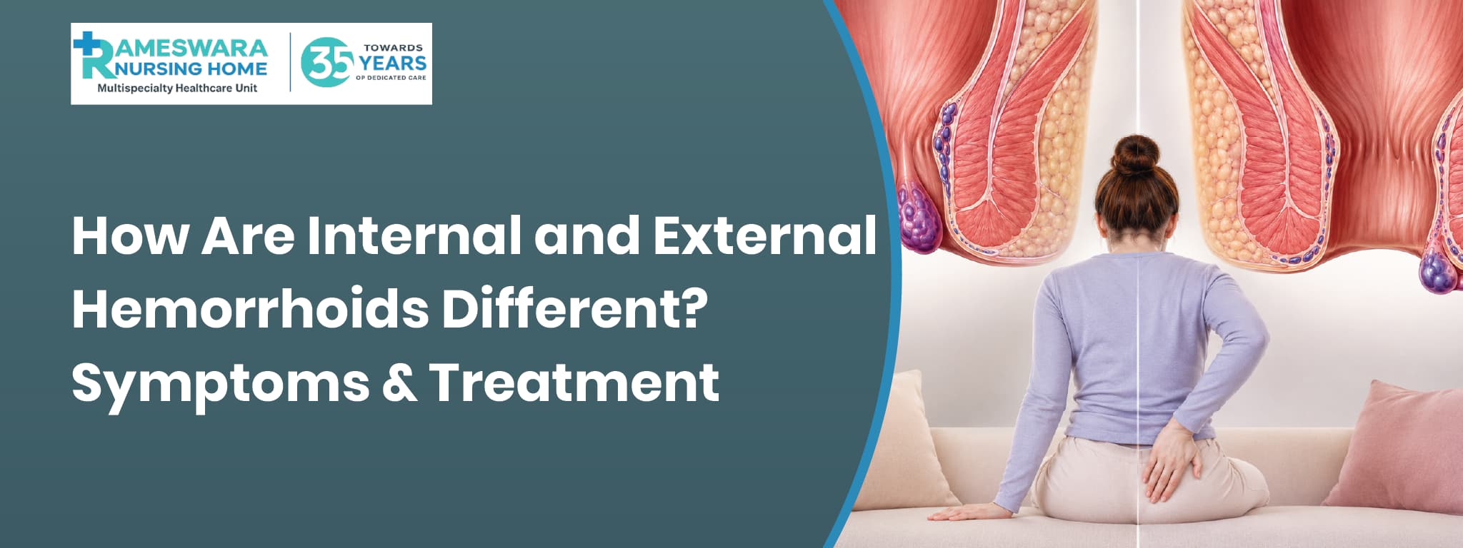 How Are Internal and External Hemorrhoids Different?01